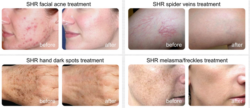 SHR Hair Removal Vascular Removal System SHR Hair Removal Vascular Removal System